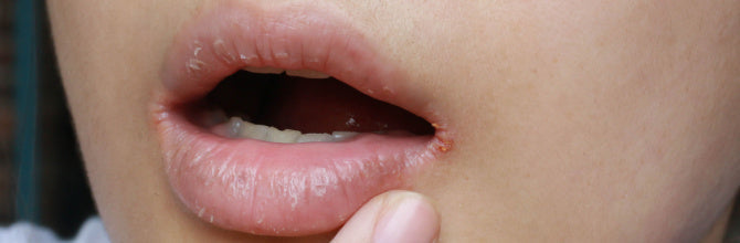 Angular Cheilitis Treatment Guide