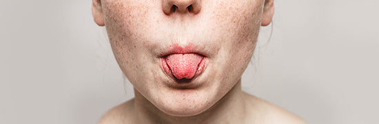 Burning Mouth Syndrome Causes and Treatments