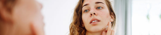 Your Ultimate Guide to Hormonal Acne in Adulthood