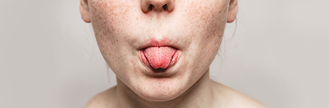 Burning Mouth Syndrome Causes And Treatments Natures Best