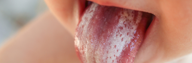 Oral Thrush Symptoms Causes And Treatments Explained Nature s Best