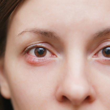 What Is a Stye and How Do I Treat One
